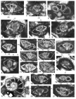 Pararotalia tuberculifera (REUSS). Upper Santonian-Lower Campanian. 1, 7, 9-15, 18-20: axial and subaxial sections. Note the massive umbilical plug on the ventral side and the proeminent beads on the dorsal side. 2: Oblique oblique centered section inclined for about 45° in respect to the coiling axis of the shell. 3: oblique section almost perpendicular to the coiling axis, showing the ventral part of the septa with their interlocular space. 4, 8: centered oblique sections inclined to about 70° in repect to the coiling axis. 5: section inclined to about 20° in respect to the coiling axis. 6: section almost perpendicular to the coiling axis. 16: oblique section inclined to about 45°. 17: section perpendicular to the coiling axis. Note the straight and radial shape of the septa on the dorsal side of the shell. The section is at the level of the foramina with their lower lip thet represent the serrated edge of the toothplate. 21: Oblique section inclined for about 45°. Note the proeminent dorsal beads. Abbreviations: ch: chamber; f: foramen; isc: intraseptal interlocular space; k: keel; ppx: paries pro- ximus; pu: pustules, that is here: beads; s: septum; sf: septal flap; tp: toothplate; upg: umbilical plug; usc: umbilico-spiral canal.

From: Boix et al. 2009 - Late Cretaceous rotaliids (Foraminiferida) from the Western Tethys