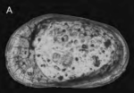 Holotype of Tuberoloxoconcha aielloi Parisi, Mazzini & Cronin in Parisi, Cronin, Aiello, Barra, Danielopol, Horne & Mazzini, 2024