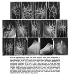 Thaumatoconcha radiata Kornicker & Sohn, 1976 from the original description